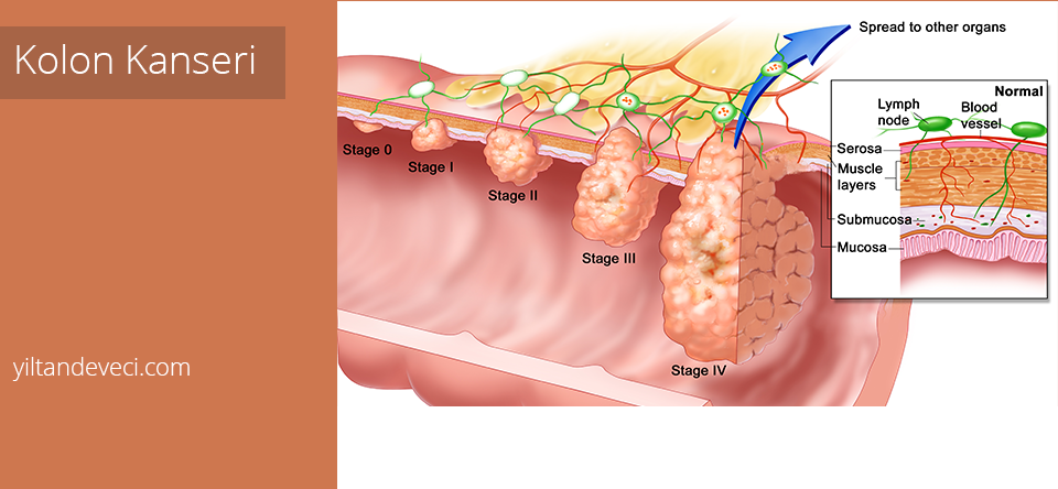 Bağırsak Kanseri Tedavisi