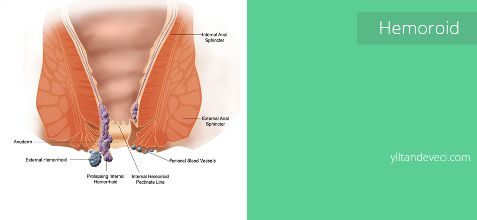 Hemoroid Tedavisi