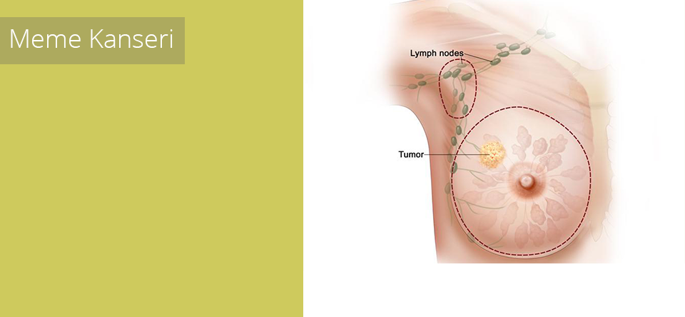 Meme Kanseri Tedavisi